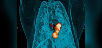 blog tb petct