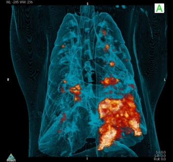 petct